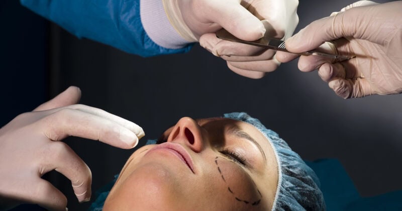 A person with marks on their face is lying down while two gloved hands, one holding a surgical instrument, perform a cosmetic surgery procedure.